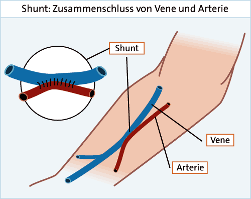Grafik: Shunt Grafik: Shunt
