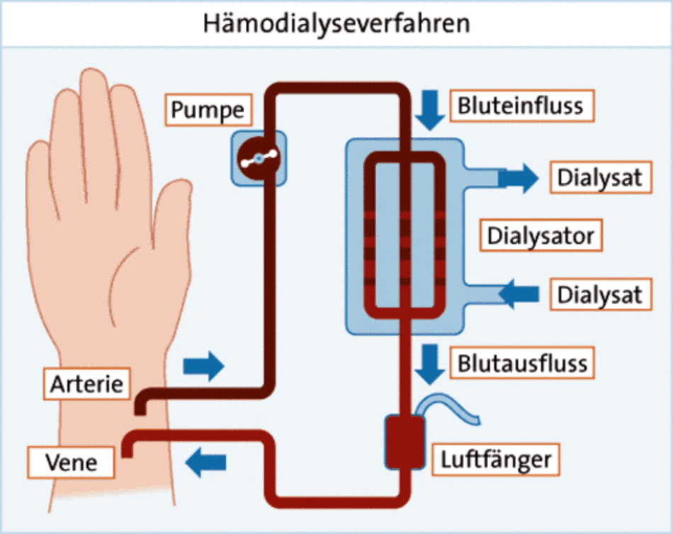 Grafik: Hämodialyse Grafik: Hämodialyse