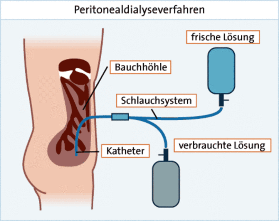 Grafik: Peritonealdialyse Grafik: Peritonealdialyse